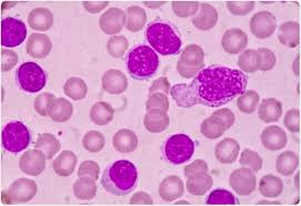 Aug 28, 2019 · leukemia is a cancer caused by an overproduction of damaged white blood cells. Prognosi Cronica Di Leucemia Cll Linfocitaria