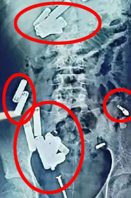 Boy, 15, dies after surgeons remove 56 metal items from stomach including razor blades - The Mirror