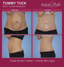 What is a fleur de li? Fleur De Lis Abdominoplasty Melbourne Dr Carmen Munteanu