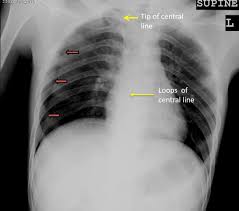 Image result for Pneumothorax
