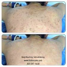 Skin lightening is a process used for people who want to lighten certain areas of skin that are affected by such things as melasma, age spots or even freckles. Client Body Bleaching Results Liz Skincare Wellness Beauty Blog