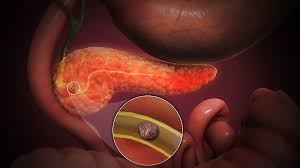 Non ignorare mai questi 5 segnali di pancreatite acuta