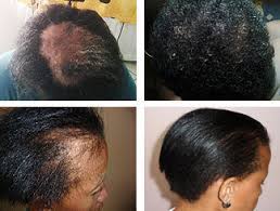 The cost of each session is from $200 to $500. Laser Hair Loss Therapy Treatment Non Surgical Treatment For Hair Loss