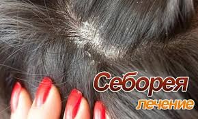 как избавиться от перхоти и выпадения волос в домашних условиях Kak Voznikaet Seboreya Kozhi Golovy I Lici I Chem Lechit Nepriyatnoe Zabolevanie V Domashnih Usloviyah Kozha Golovy Maski Dlya Volos Shampun