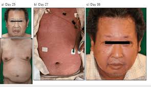 Rash thought to have been caused by olanzapine-induced...