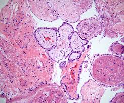 It occurs in premenopausal women with prior gynaecological surgery or infection that results in peritoneal scarring. Pathology Outlines Peritoneum Well Differentiated Papillary Mesothelioma