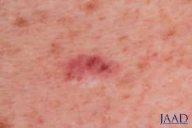 Shave biopsy wounds heal by secondary intention. Jaad Journals On Twitter Effects Of Curettage After Shave Biopsy Of Unexpected Melanoma A Retrospective Review Https T Co Diqw2u22ip