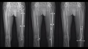 Image result for Functional Leg Length Discrepancy