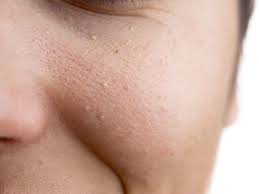 See full list on wikihow.com How To Get Rid Of Milia Treatment Prevention And Causes