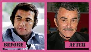 Did burt reynolds have plastic surgery? Burt Reynolds Plastic Surgery An Interesting Case