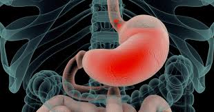 Free online translation from french, russian, spanish, german, italian and a number of other languages into english and back, dictionary with transcription, pronunciation, and examples of usage. Reflux Gastro Oesophagien Brulures D Estomac Symptomes
