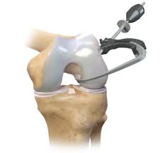 The acl relation contrasts with the advcl relation, which is used for adverbial clauses that modify a predicate. Arthrex Acl Retroconstruction System Flipcutter Iii Drill