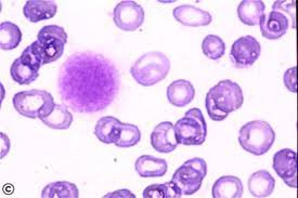 A normal human platelet count ranges from 150,000 to 450. Que Es La Trombocitopenia Blog De Farmacia