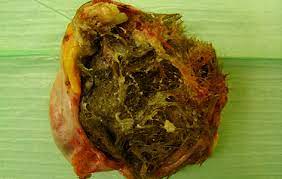 tumoren mit zahnen und knochen science orf at