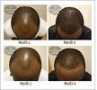 Hair Growth Before And After 1 Year