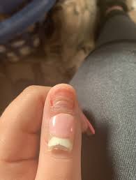 Sorry like always that my english it is not great but i thought. Hit My Acrylic Nail Resulting In Lifting My Real Nail And I Believe Pushing The Nail Bed To Skin Nail Disorders Forums Patient