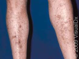 Image result for Pigment stains on the shin