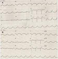 More specifically, it is described as. Acute Myocarditis Mimicking Myocardial Infarction Can Misdirect The Diagnostic Approach Sciencedirect