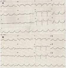 Myocarditis (mk) is a cardiovascular disease characterized by heart muscle damage due to the development of inflammation in the tissues of the the most frequent ecg signs of myocarditis Acute Myocarditis Mimicking Myocardial Infarction Can Misdirect The Diagnostic Approach Sciencedirect