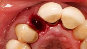 Extremely hot or cold foods may cause soreness in the. Dental Dry Socket Problems After Wisdom Tooth Extraction Online Dry Socket Chat