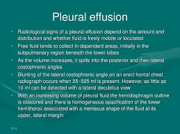 They may result from a variety of pathological processes which overwhelm the pleura's ability to reabsorb fluid. Imaging Pattern Of Respiratory Disease Ppt Download
