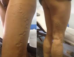 Pelvic Congestion Syndrome I Josef Pflug Vascular Laboratory