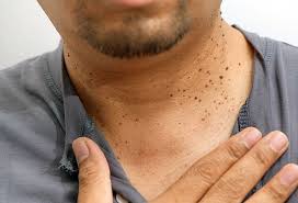 Most people have experienced lumps in some form, especially if they're older. Why Do I Get Skin Tags On My Neck