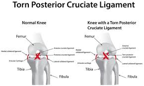 Ligament most commonly refers to a band of tough, fibrous dense regular connective tissue comprising attenuated collagenous fibers. Posterior Cruciate Ligament Injury