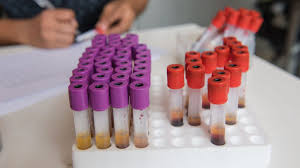 Measuring Procalcitonin In Sputum May Help Manage Bronchiectasis Flares El planeta hace que las estrellas.