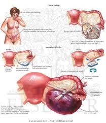I Have Been Through This Didn T Even Know This Was A Thing Scary Stuff Dm Ovarian Torsion Medical Illustration Ovarian Diagnostic Medical Sonography