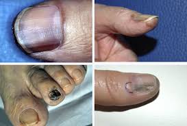 Image result for Acral lentiginous melanoma nail