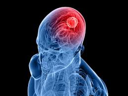 As your tumor grows, it can press on surrounding tissue, affecting the function controlled by that part of the brain. A Leap Forward In Radiation Therapy For Brain Tumors Medcity News