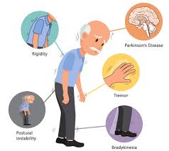 It can cause the muscles to tighten and become rigid this makes it hard to walk and do other daily activities. Parkinson S Disease Hong Kong Sanatorium Hospital Mobile Site