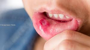Für lippenherpes ist vor allem der virus des typs 1 verantwortlich. á… Herpes Im Mund Mundfaule Ansteckung Beschwerden Und Behandlung
