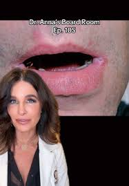 Image result for Angular Stomatitis
