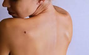 • the lesions are usually firm and hard. What S So Different About Nodular Melanoma U S Dermatology Partners Blog
