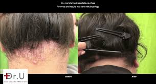 Google best doctors for hair loss you will find them, you can check the rating of the reviews so that you can be assured of the treatment offered is best. Akn Doctor Archives Dr U Hair Skin Clinic Fue Hair Restoration Dermatology And Laser Surgery Los Angeles Manhattan Beach Dr Sanusi Umar Md