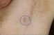 Ingrown Hair Underarm Boil
