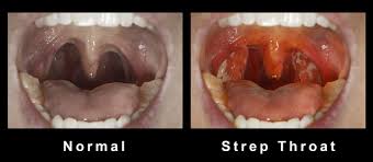Image result for Strep throat infection roof of mouth