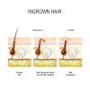 Ingrown Pubic Hair Hard Lump