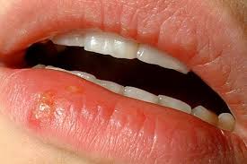 Herpes Fur Immer Und Ewig Dermatologie Derstandard At Gesundheit