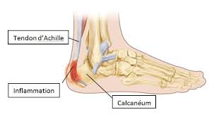 Calcium can often build up in tendons and tissues near a joint, which causes pain and makes movement difficult. Maladie De Sever Douleur Au Talon Chez L Enfant