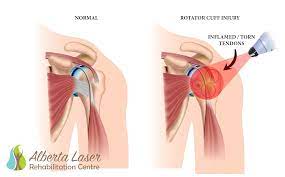 Case Study Supraspinatus Tendon Tear