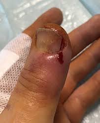 Image result for paronychium