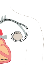 If yoda goes into cardiac arrest, will you know what to do? Https Biotronik Cdn Mediamid Com Cdn Bio Doc Bio32126 85662 Bio32126 Pdf