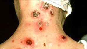 Maybe you would like to learn more about one of these? For Sekundaer Fersk Syfilis Karakteristisk For Utseendet Sekundaer Syfilis Symptomer Behandling Og Metoder For Forebygging