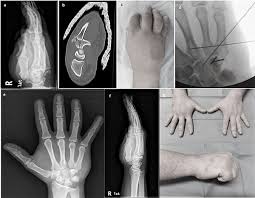 Image result for Hamate Bone