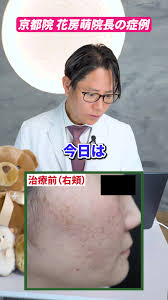 耳のピアスホールの粉瘤取り出し方の解説