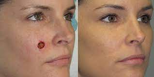 Understanding the symptoms and the risks associated with each type of skin cancer will help you determine the right course of treatment. Cheek Reconstruction Gallery Skin Cancer And Reconstructive Surgery Center