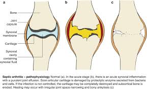 Image result for Septic Joint